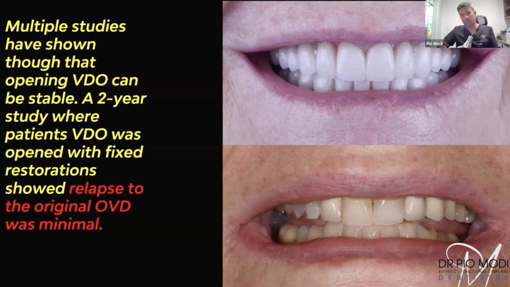 Image of teeth with text on screen of Saving Natural Teeth and Worn Dentition Treatment